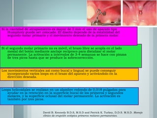 David B. Kennedy B.D.S, M.S.D and Patrick K. Turkey, D.D.S. M.S.D. Manejo
clínico de erupción ectópica primeros molares permanentes.
 