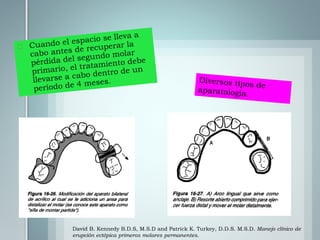 David B. Kennedy B.D.S, M.S.D and Patrick K. Turkey, D.D.S. M.S.D. Manejo clínico de
erupción ectópica primeros molares permanentes.
 