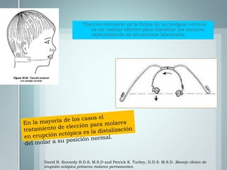 David B. Kennedy B.D.S, M.S.D and Patrick K. Turkey, D.D.S. M.S.D. Manejo clínico de
erupción ectópica primeros molares permanentes.
 