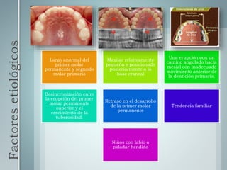 Factoresetiológicos
Largo anormal del
primer molar
permanente y segundo
molar primario
Maxilar relativamente
pequeño o posicionado
posteriormente a la
base craneal
Una erupción con un
camino angulado hacia
mesial con inadecuado
movimiento anterior de
la dentición primaria.
Desincronización entre
la erupción del primer
molar permanente
superior y el
crecimiento de la
tuberosidad.
Retraso en el desarrollo
de la primer molar
permanente
Tendencia familiar
Niños con labio o
paladar hendido
 