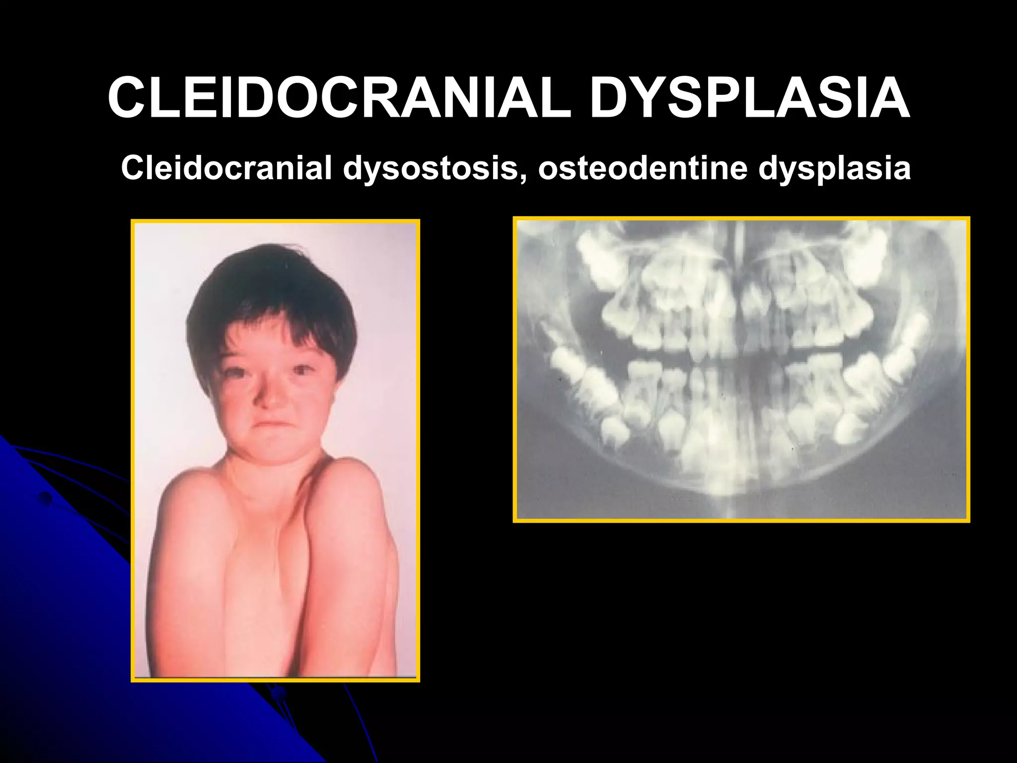 CLEIDOCRANIAL DYSPLASIACLEIDOCRANIAL DYSPLASIA
Cleidocranial dysostosis, osteodentine dysplasia
 
