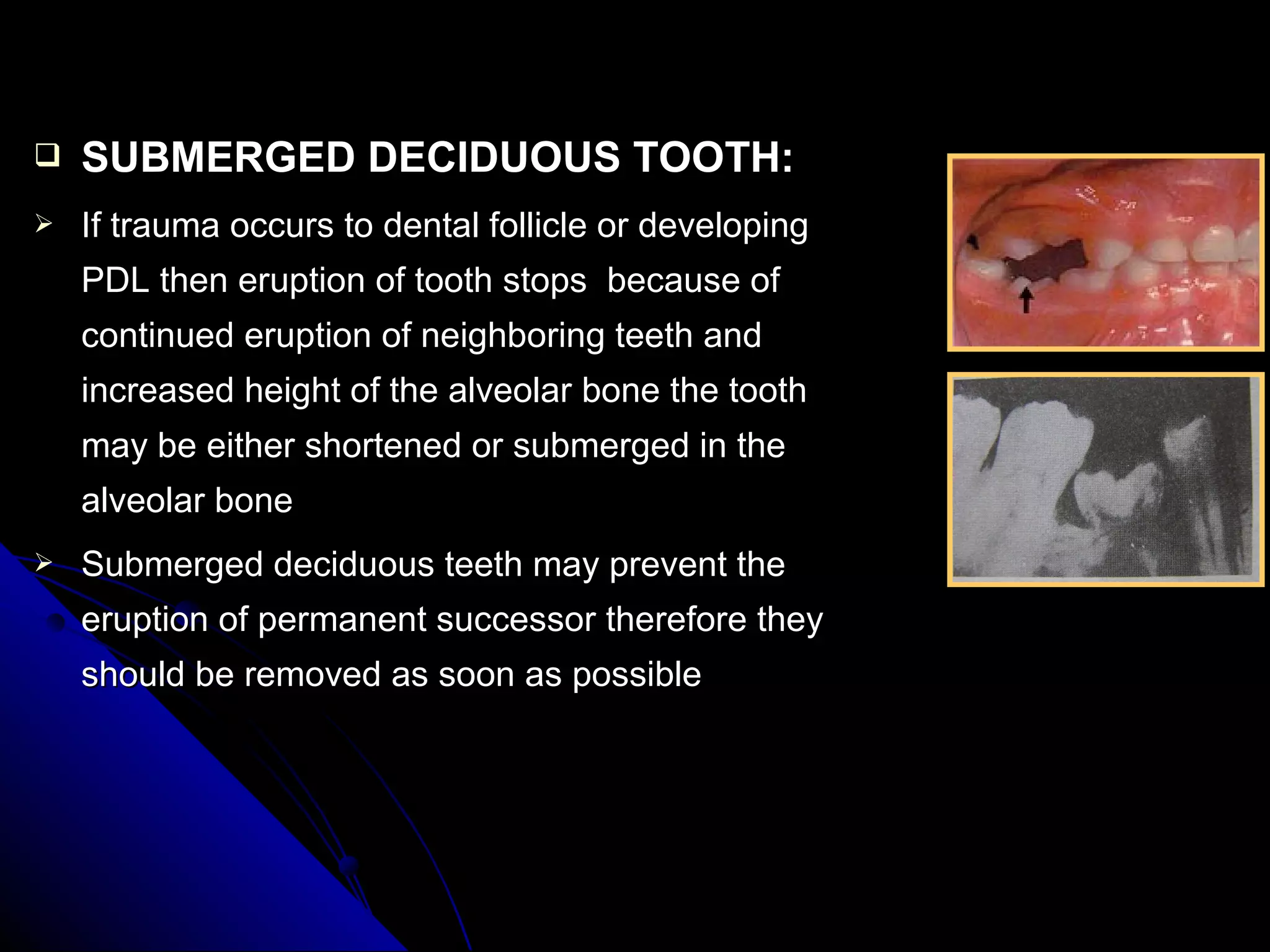  SUBMERGED DECIDUOUS TOOTH:SUBMERGED DECIDUOUS TOOTH:
 If trauma occurs to dental follicle or developingIf trauma occurs to dental follicle or developing
PDL then eruption of tooth stops because ofPDL then eruption of tooth stops because of
continued eruption of neighboring teeth andcontinued eruption of neighboring teeth and
increased height of the alveolar bone the toothincreased height of the alveolar bone the tooth
may be either shortened or submerged in themay be either shortened or submerged in the
alveolar bonealveolar bone
 Submerged deciduous teeth may prevent theSubmerged deciduous teeth may prevent the
eruption of permanent successor therefore theyeruption of permanent successor therefore they
should be removed as soon as possibleshould be removed as soon as possible
 