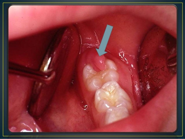 Image result for eruption gingivitis images