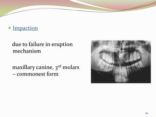  Impaction
due to failure in eruption
mechanism
maxillary canine, 3rd molars
– commonest form
66
 