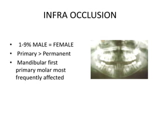 INFRA OCCLUSION
• 1-9% MALE = FEMALE
• Primary > Permanent
• Mandibular first
primary molar most
frequently affected

 