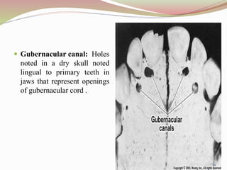 12
 Gubernacular canal: Holes
noted in a dry skull noted
lingual to primary teeth in
jaws that represent openings
of gubernacular cord .
 
