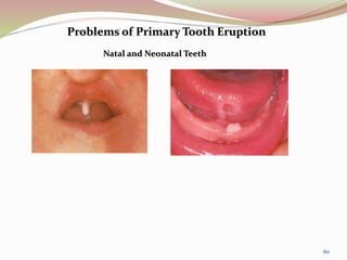 Problems of Primary Tooth Eruption
Natal and Neonatal Teeth
60
 