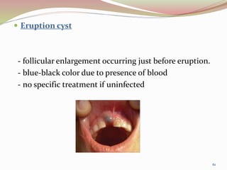  Eruption cyst
- follicular enlargement occurring just before eruption.
- blue-black color due to presence of blood
- no specific treatment if uninfected
61
 