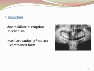  Impaction
due to failure in eruption
mechanism
maxillary canine, 3rd molars
– commonest form
66
 