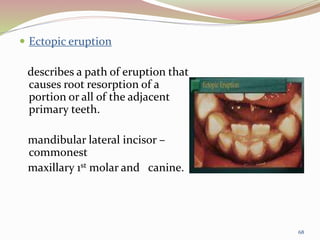  Ectopic eruption
describes a path of eruption that
causes root resorption of a
portion or all of the adjacent
primary teeth.
mandibular lateral incisor –
commonest
maxillary 1st molar and canine.
68
 
