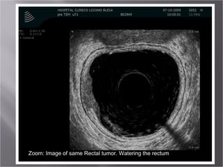 Zoom: Image of same Rectal tumor. Watering the rectum 