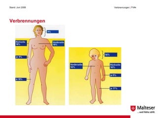 Verbrennungen Stand: Juni 2008 Verbrennungen  | Folie 