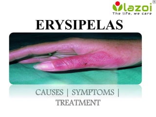 ERYSIPELAS
CAUSES | SYMPTOMS |
TREATMENT
 