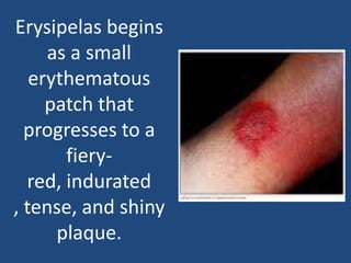 Erysipelas begins
as a small
erythematous
patch that
progresses to a
fiery-
red, indurated
, tense, and shiny
plaque.
 