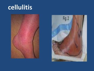 cellulitis
 