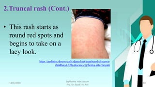 Erythema infectiosum (fifth disease) | PPTX