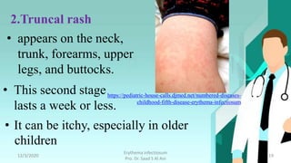 Erythema infectiosum (fifth disease) | PPTX