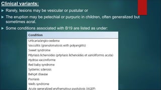Clinical variants:
 Rarely, lesions may be vesicular or pustular or
 The eruption may be petechial or purpuric in children, often generalized but
sometimes acral.
 Some conditions associated with B19 are listed as under:
 
