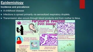 Epidemiology
Incidence and prevalence:
 A childhood disease
 Infections is spread primarily via aerosolized respiratory droplets.
 Transmission also occurs through blood products and from mother to fetus.
 