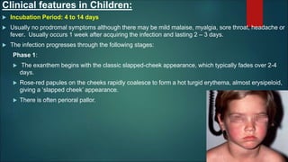 Clinical features in Children:
 Incubation Period: 4 to 14 days
 Usually no prodromal symptoms although there may be mild malaise, myalgia, sore throat, headache or
fever. Usually occurs 1 week after acquiring the infection and lasting 2 – 3 days.
 The infection progresses through the following stages:
Phase 1:
 The exanthem begins with the classic slapped-cheek appearance, which typically fades over 2-4
days.
 Rose‐red papules on the cheeks rapidly coalesce to form a hot turgid erythema, almost erysipeloid,
giving a ‘slapped cheek’ appearance.
 There is often perioral pallor.
 
