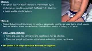 Phase 2:
 This phase occurs 1-4 days later and is characterized by an
erythematous maculo-papular rash that fades in 2-4 days into
a classic lacelike reticular pattern.
Phase 3:
 Frequent clearing and recurrences for weeks or occasionally months may occur due to stimuli such as
exercise, irritation, stress, or overheating of the skin from sunlight or bathing in hot water
 Other Clinical Features:
 Palms and soles may be involved and acral lesions may be petechial.
 There may be dark‐red macules on the buccal and genital mucous membranes.
 The patient is no longer infectious when the rash appears.
 