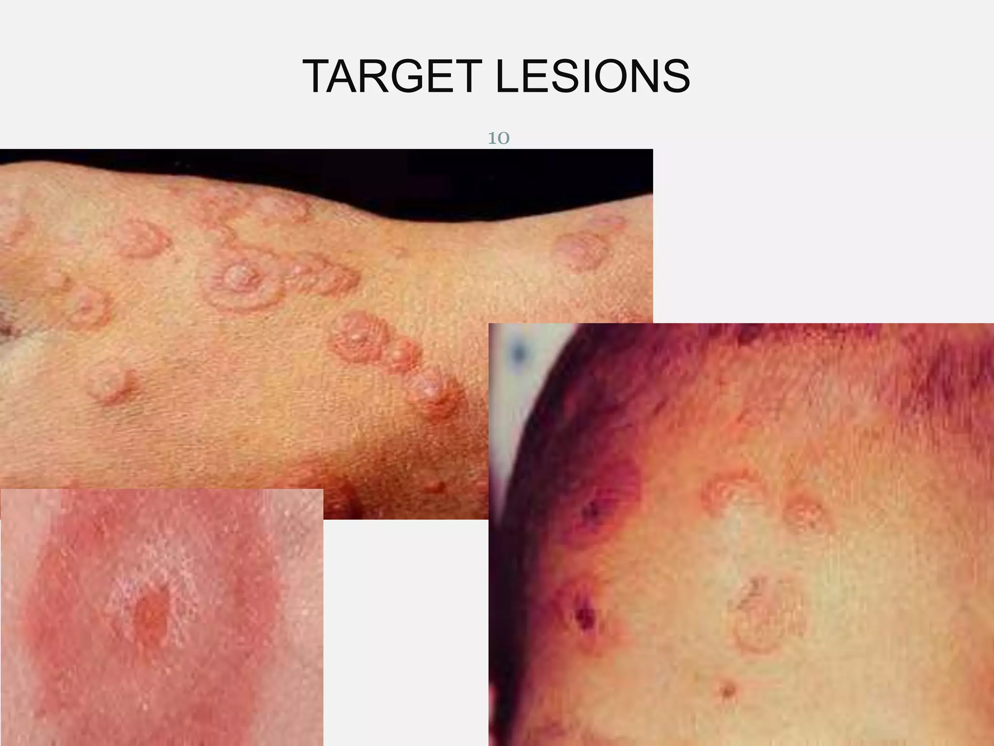 TARGET LESIONS
10

12/29/2013

 