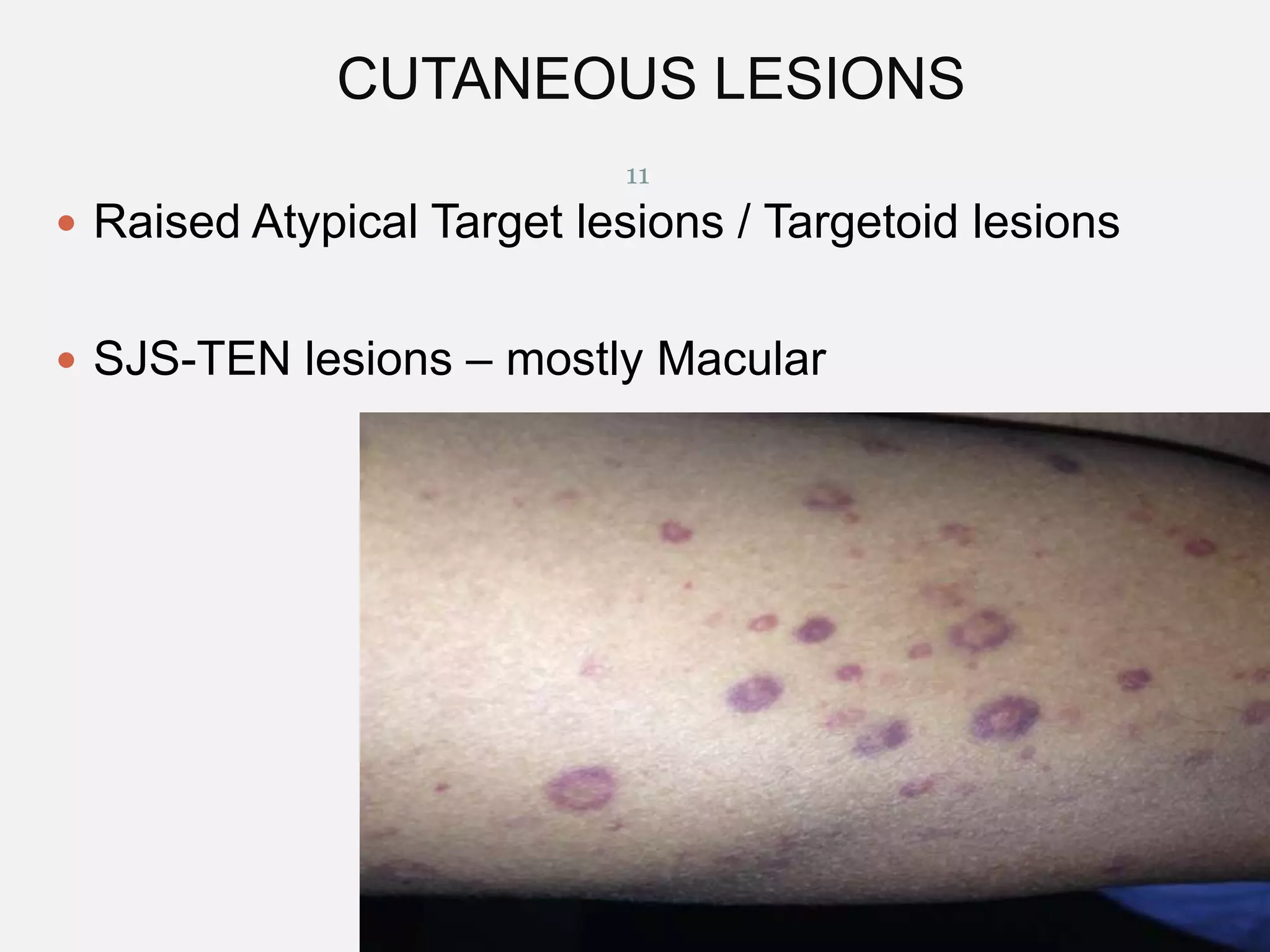 CUTANEOUS LESIONS
11

 Raised Atypical Target lesions / Targetoid lesions

 SJS-TEN lesions – mostly Macular

12/29/2013

 