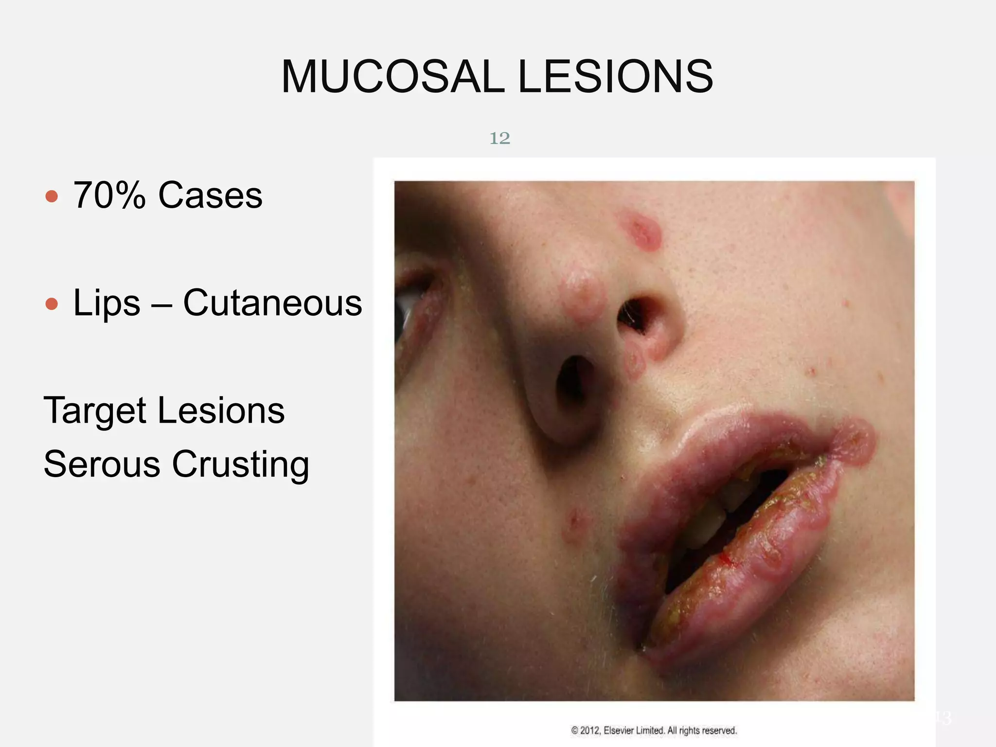 MUCOSAL LESIONS
12

 70% Cases
 Lips – Cutaneous

Target Lesions
Serous Crusting

12/29/2013

 