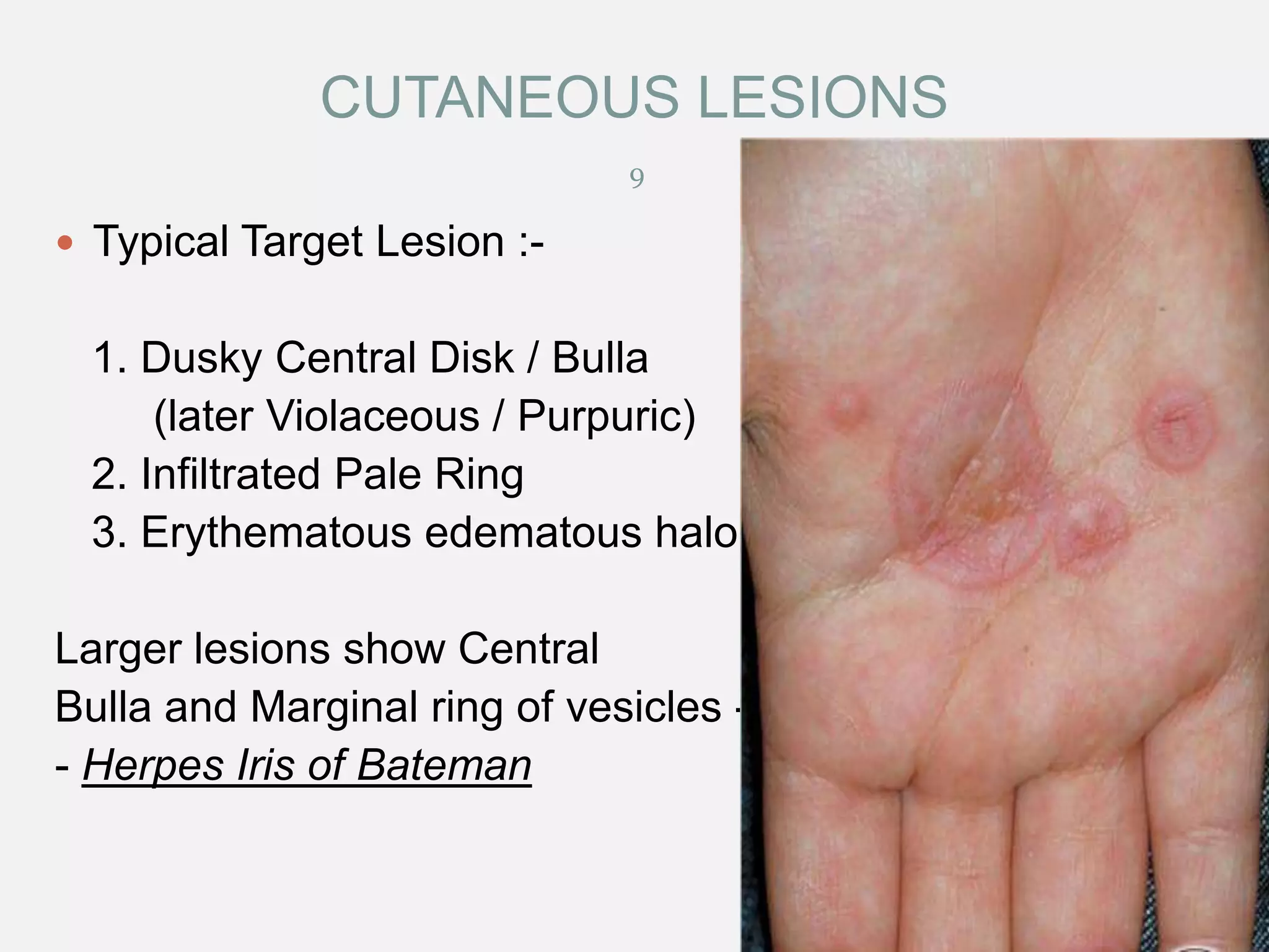 CUTANEOUS LESIONS
9

 Typical Target Lesion :-

1. Dusky Central Disk / Bulla
(later Violaceous / Purpuric)
2. Infiltrated Pale Ring
3. Erythematous edematous halo
Larger lesions show Central
Bulla and Marginal ring of vesicles - Herpes Iris of Bateman
12/29/2013

 