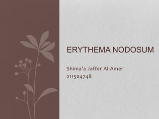 Shima’a Jaffer Al-Amer
211504748
ERYTHEMA NODOSUM
 