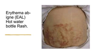 Erythema (redness of skin) | PPTX
