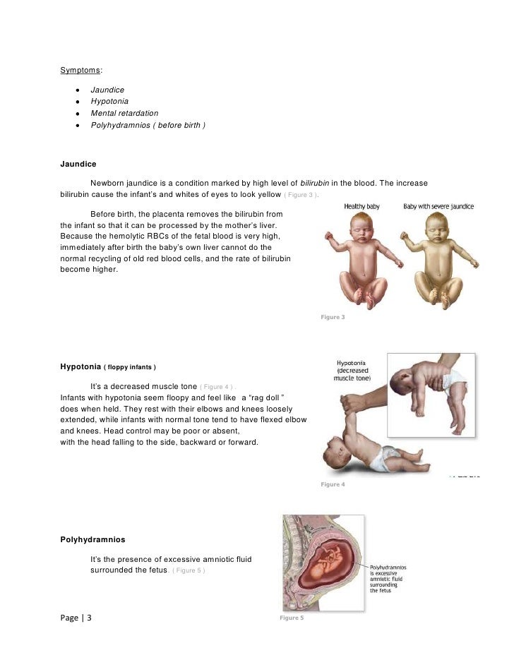 erythroblastosis fetalis