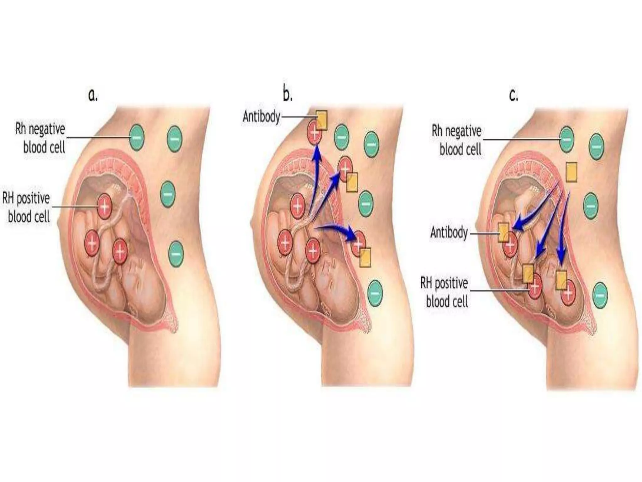 Erythroblastosis fetalis | PPTX