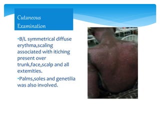 •B/L symmetrical diffuse
erythma,scaling
associated with itiching
present over
trunk,face,scalp and all
extemities.
•Palms,soles and genetilia
was also involved.
Cutaneous
Examination
 
