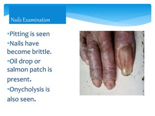•Pitting is seen
•Nails have
become brittle.
•Oil drop or
salmon patch is
present.
•Onycholysis is
also seen.
Nails Examination
 