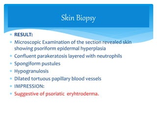  RESULT:
 Microscopic Examination of the section revealed skin
showing psoriform epidermal hyperplasia
 Confluent parakeratosis layered with neutrophils
 Spongiform pustules
 Hypogranulosis
 Dilated tortuous papillary blood vessels
 IMPRESSION:
 Suggestive of psoriatic eryhtroderma.
Skin Biopsy
 
