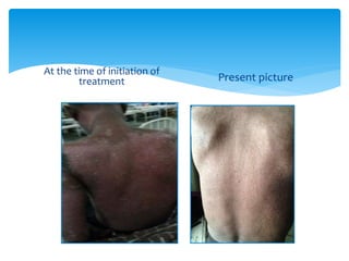At the time of initiation of
treatment Present picture
 