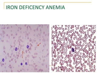 IRON DEFICENCY ANEMIA
 