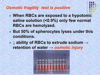 Osmotic fragility test is positive
 When RBCs are exposed to a hypotonic
saline solution (<0.9%) only few normal
RBCs are hemolyzed.
 But 50% of spherocytes lyses under this
conditions.
 ↓ ability of RBCs to extrude sodium →
retention of water → osmotic injury
 
