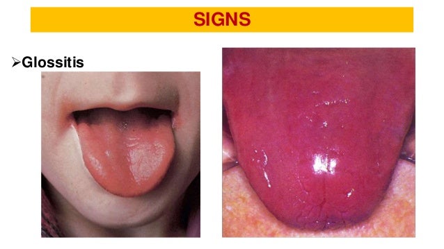 Erythropoiesis,Anemia,Iron Deficiency Anemia by Dr. Sookun ...