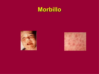 Morbillo 