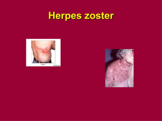 Herpes zoster 
