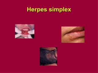 Herpes simplex 