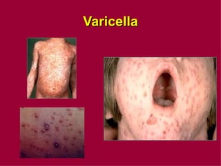 Varicella 