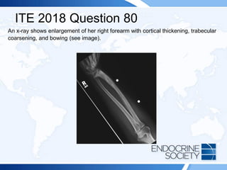 ITE 2018 Question 80
An x-ray shows enlargement of her right forearm with cortical thickening, trabecular
coarsening, and bowing (see image).
 