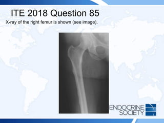 ITE 2018 Question 85
X-ray of the right femur is shown (see image).
 