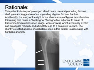 Rationale:
This patient’s history of prolonged alendronate use and preceding femoral
shaft pain are suggestive of an impending atypical femoral fracture.
Additionally, the x-ray of the right femur shows areas of typical lateral cortical
thickening that cause a “beaking” or “flaring” effect adjacent to areas of
transverse fracture lines (see image, white arrows), which eventually evolve
and propagate medially and ultimately lead to a complete fracture. The
slightly elevated alkaline phosphatase seen in this patient is associated with
her bone anomaly.
 