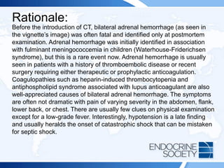Rationale:
Before the introduction of CT, bilateral adrenal hemorrhage (as seen in
the vignette’s image) was often fatal and identified only at postmortem
examination. Adrenal hemorrhage was initially identified in association
with fulminant meningococcemia in children (Waterhouse-Friderichsen
syndrome), but this is a rare event now. Adrenal hemorrhage is usually
seen in patients with a history of thromboembolic disease or recent
surgery requiring either therapeutic or prophylactic anticoagulation.
Coagulopathies such as heparin-induced thrombocytopenia and
antiphospholipid syndrome associated with lupus anticoagulant are also
well-appreciated causes of bilateral adrenal hemorrhage. The symptoms
are often not dramatic with pain of varying severity in the abdomen, flank,
lower back, or chest. There are usually few clues on physical examination
except for a low-grade fever. Interestingly, hypotension is a late finding
and usually heralds the onset of catastrophic shock that can be mistaken
for septic shock.
 