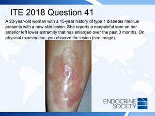 ITE 2018 Question 41
A 23-year-old woman with a 15-year history of type 1 diabetes mellitus
presents with a new skin lesion. She reports a nonpainful sore on her
anterior left lower extremity that has enlarged over the past 3 months. On
physical examination, you observe the lesion (see image).
 