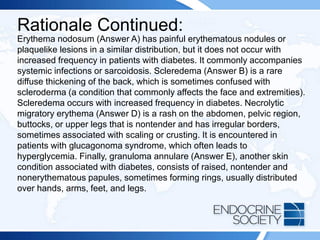Rationale Continued:
Erythema nodosum (Answer A) has painful erythematous nodules or
plaquelike lesions in a similar distribution, but it does not occur with
increased frequency in patients with diabetes. It commonly accompanies
systemic infections or sarcoidosis. Scleredema (Answer B) is a rare
diffuse thickening of the back, which is sometimes confused with
scleroderma (a condition that commonly affects the face and extremities).
Scleredema occurs with increased frequency in diabetes. Necrolytic
migratory erythema (Answer D) is a rash on the abdomen, pelvic region,
buttocks, or upper legs that is nontender and has irregular borders,
sometimes associated with scaling or crusting. It is encountered in
patients with glucagonoma syndrome, which often leads to
hyperglycemia. Finally, granuloma annulare (Answer E), another skin
condition associated with diabetes, consists of raised, nontender and
nonerythematous papules, sometimes forming rings, usually distributed
over hands, arms, feet, and legs.
 